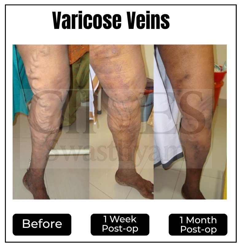 Varicose vein treatment: Before & after