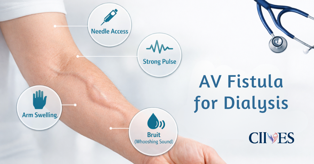 AV Fistula for Dialysis
