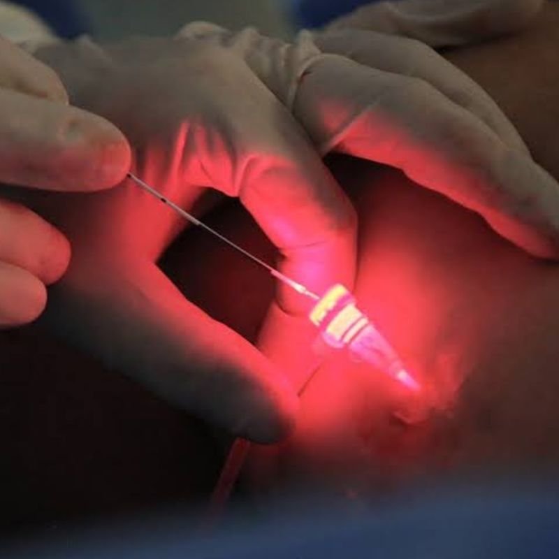 LASER seals damaged veins using heat