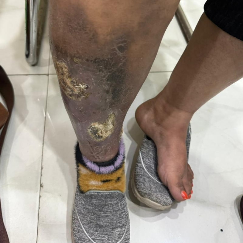 Hardening of skin