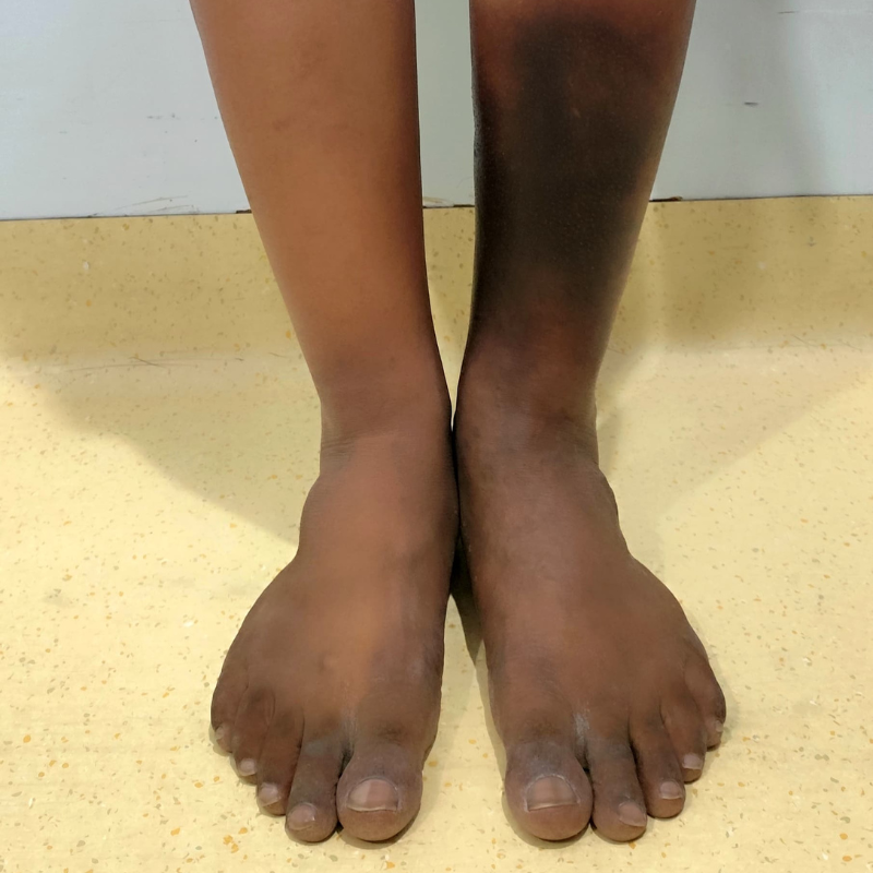 Skin discolouration