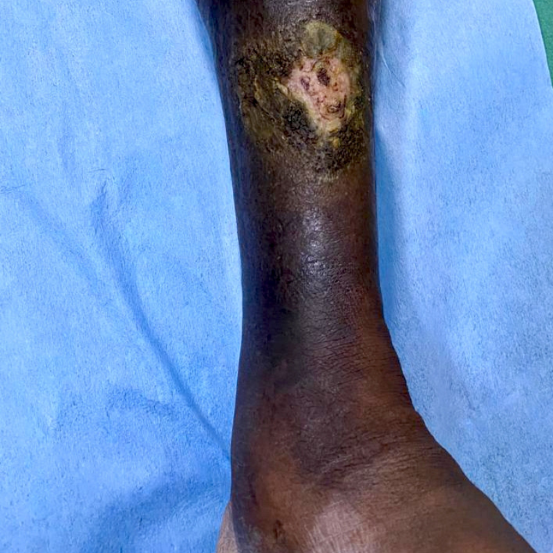 Chronic DVT