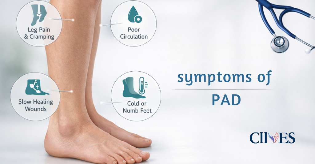 Symptoms of PAD