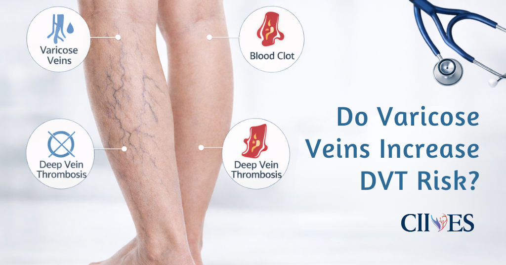 Do Varicose Veins Increase DVT Risk?