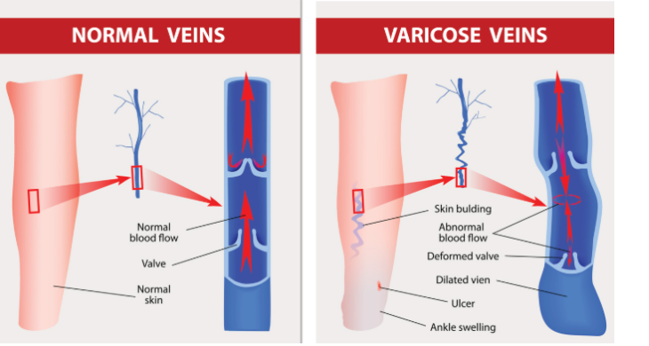 Normal vs varicose veins
