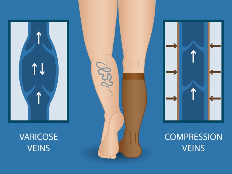 Compression stockings for varicose veins