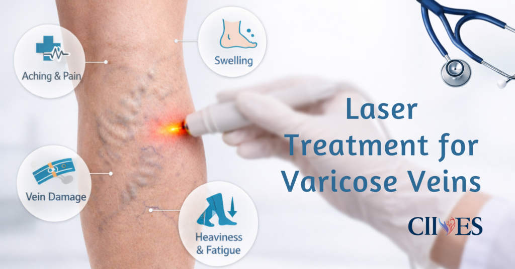 Laser Treatment for Varicose Veins