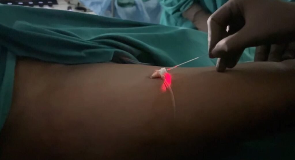 Laser for varicose veins