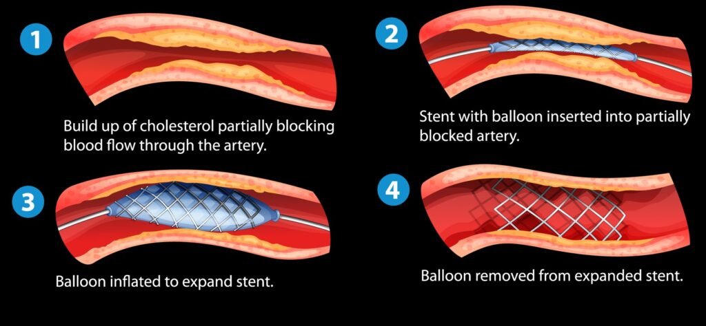 Peripheral angioplasty