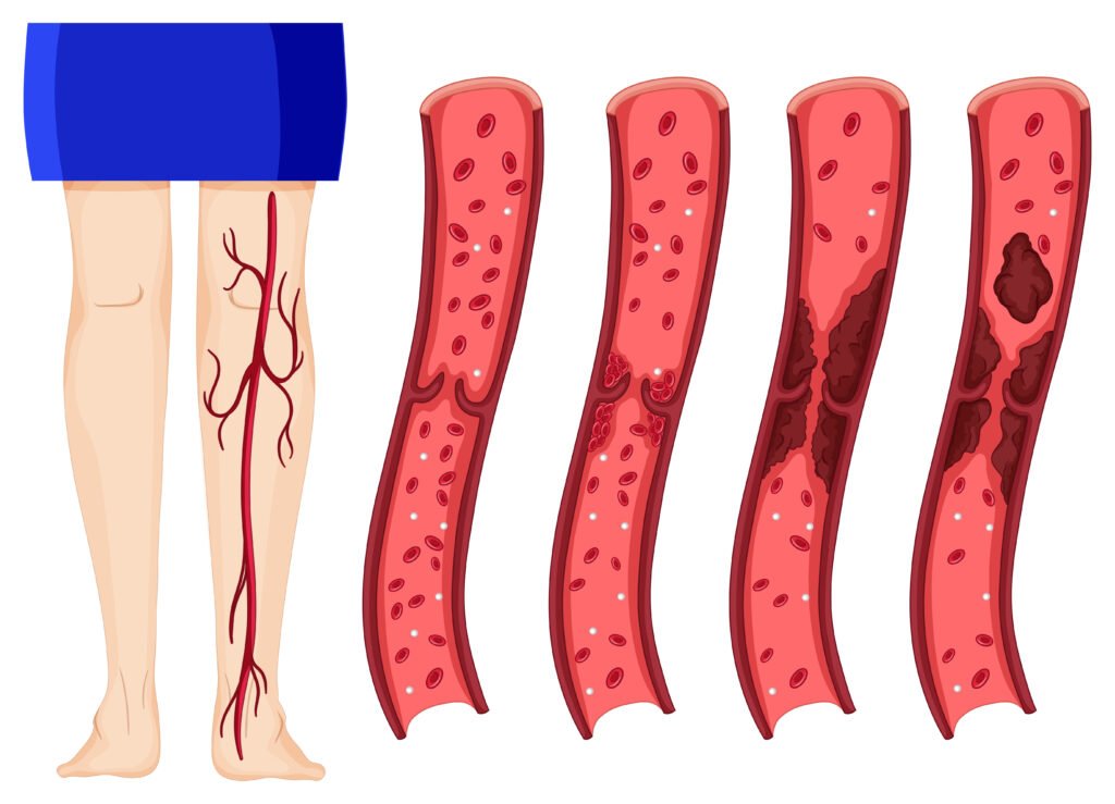 DVT Symptoms Causes Treatment