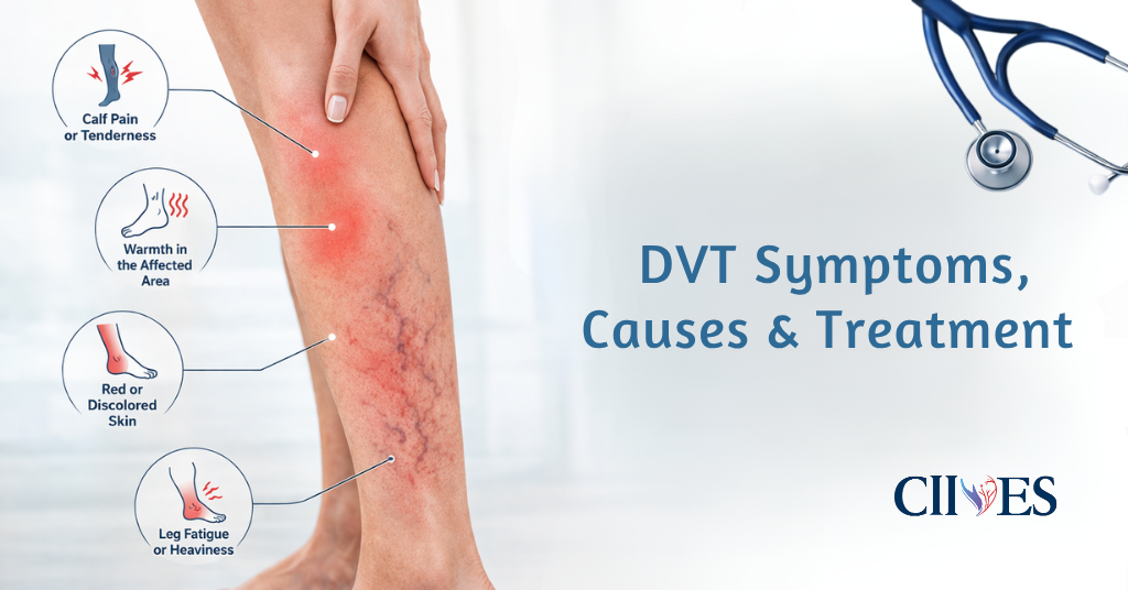 DVT Symptoms, Causes & Treatment