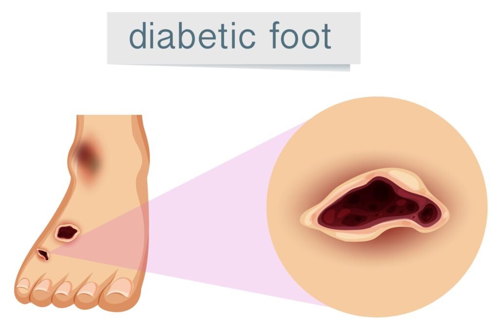 diabetic foot ulcer
