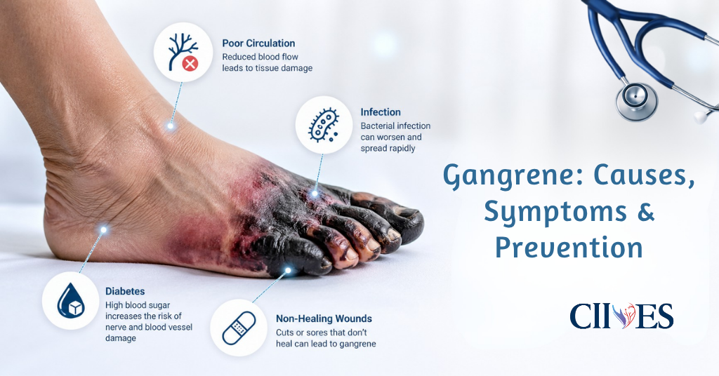 Gangrene: Causes, Symptoms & Prevention