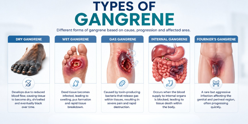 Types of gangrene pictures