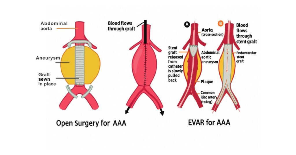AAA treatment options: Endovascular and Open aneurysm repair