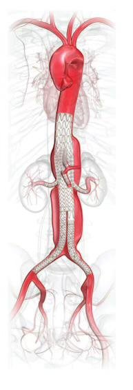 AAA treatment: Endovascular aneurysm repair (EVAR) with stent