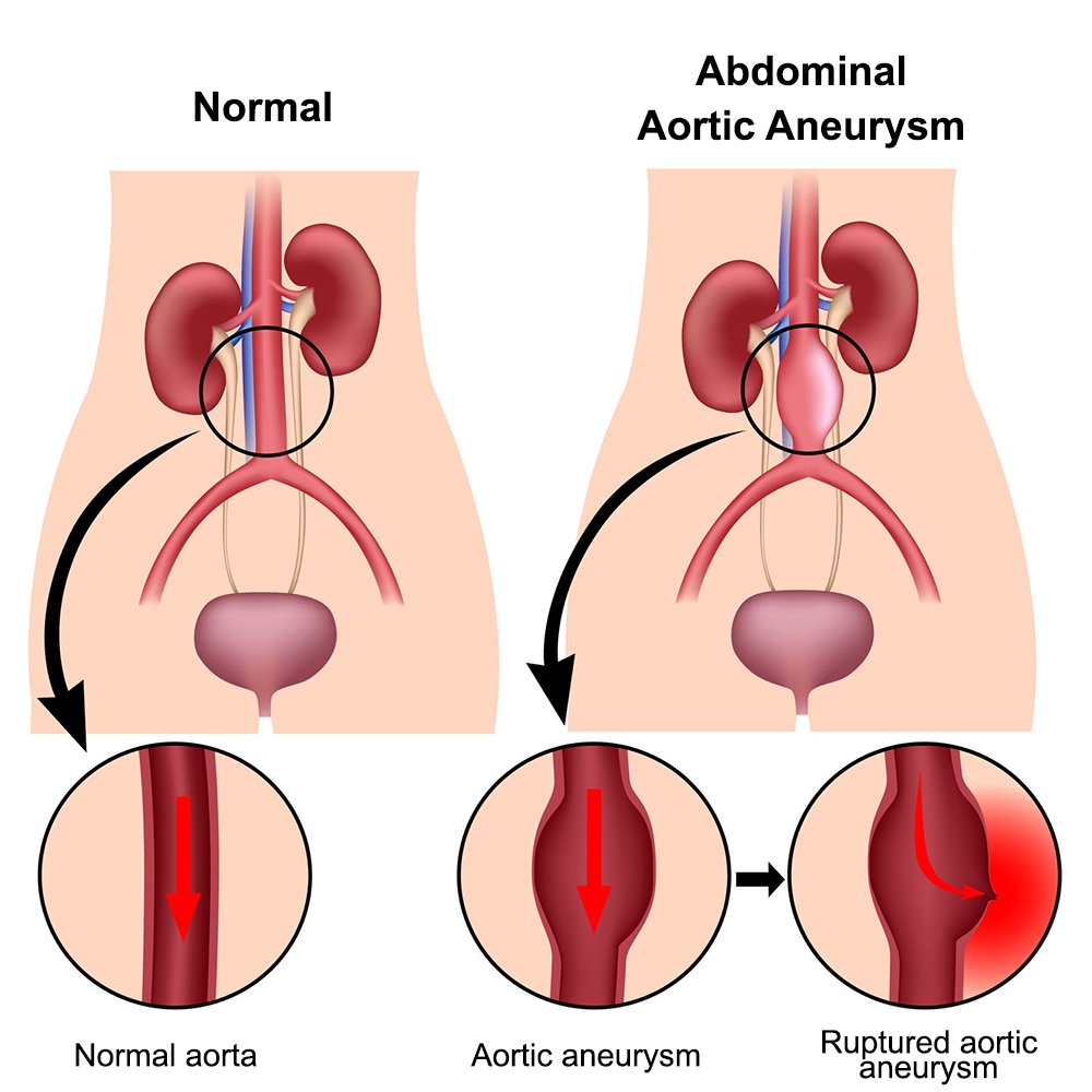 AAA treatment: Abdominal aortic aneurysm treatment