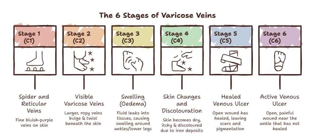 6 stages of varicose veins