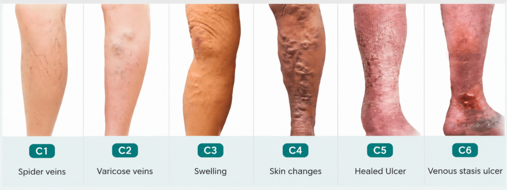Varicose veins stages