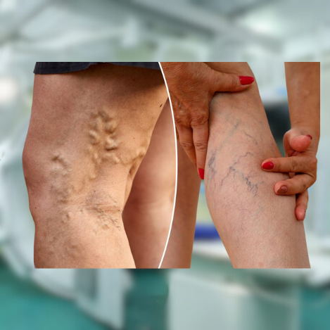 Varicose veins