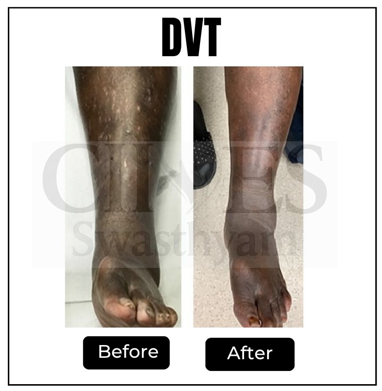 DVT case 1 operated at CIIVES dept with successful outcomes