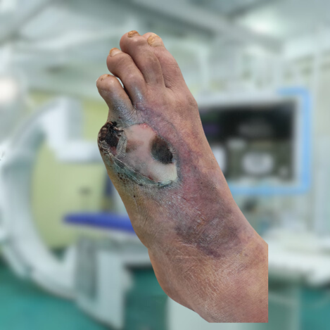 Diabetic foot with ulcer & gangrene