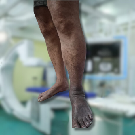 DVT or deep vein thrombosis