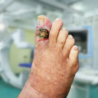 Peripheral artery disease or PAD