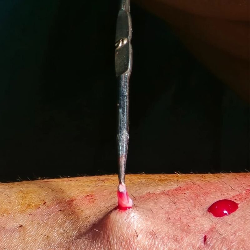 Hook phlebectomy uses a small surgical hook to remove a superficial varicose vein through a tiny skin incision.