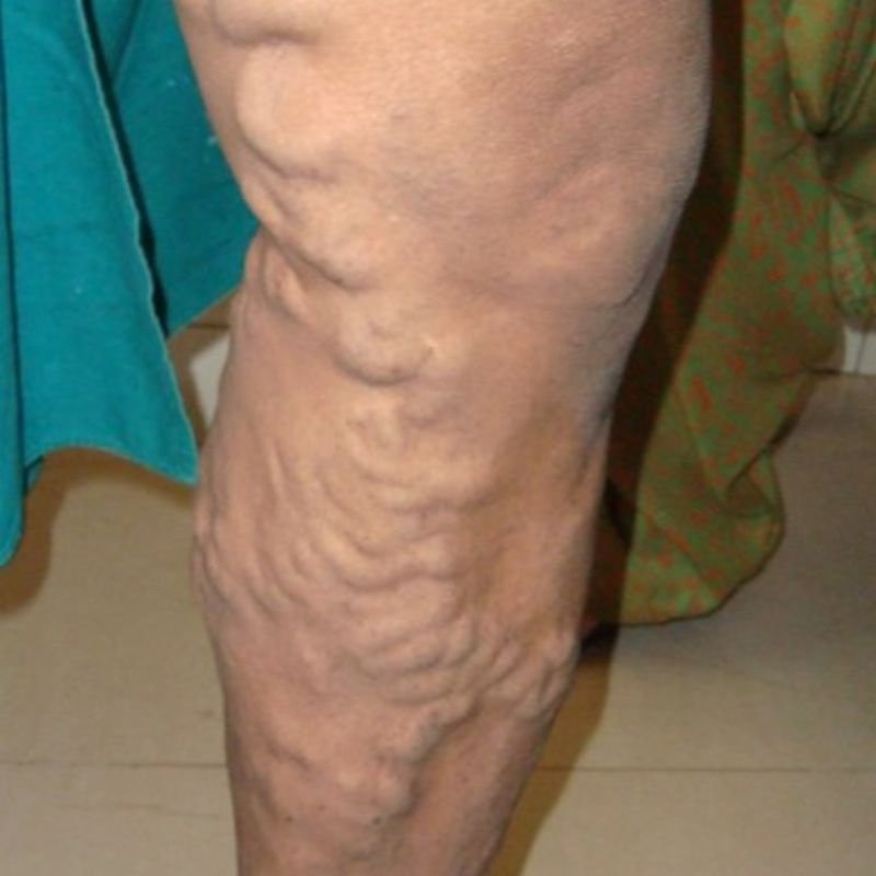 Varicose veins are enlarged, twisted veins