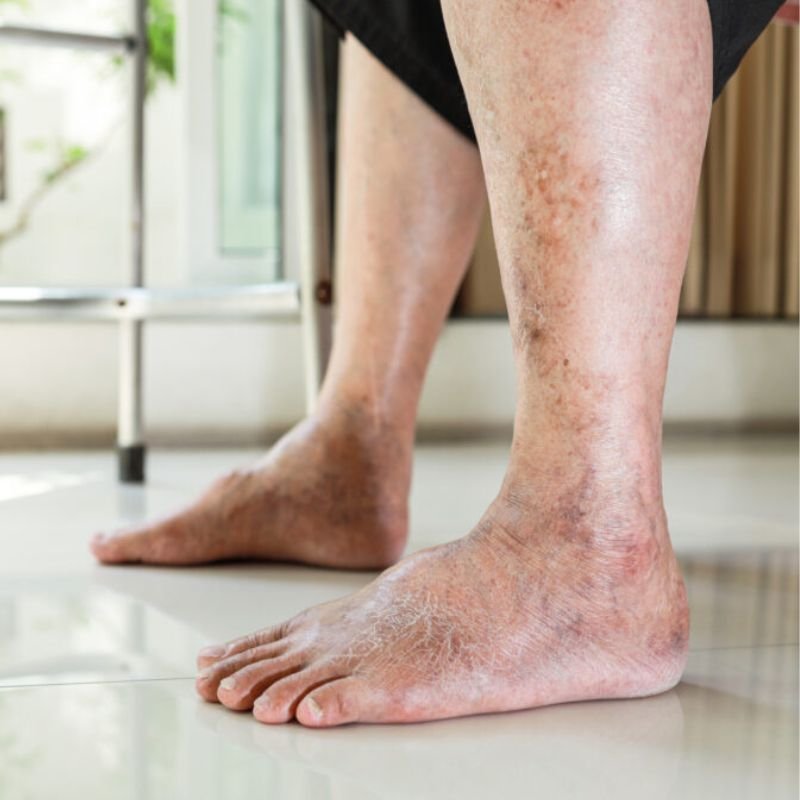 Swelling is seen in the affected leg(s) due to chronic venous insufficience