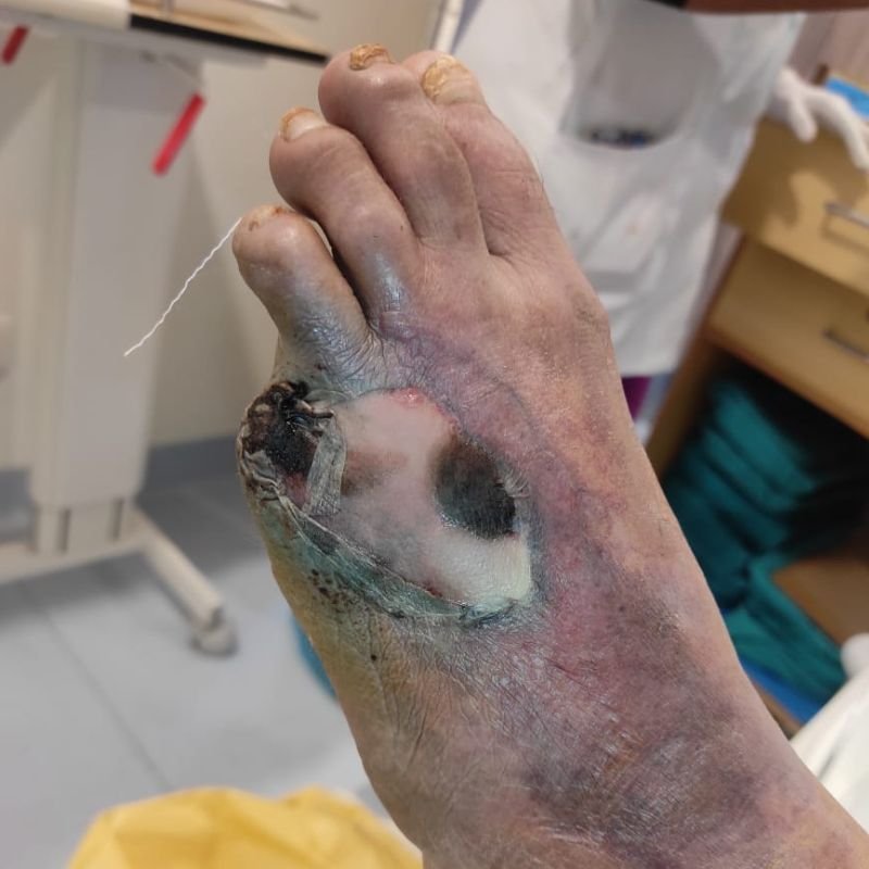 Non-healing ulcers on toes due to poor circulation may progress to gangrene (blackening) if not treated.