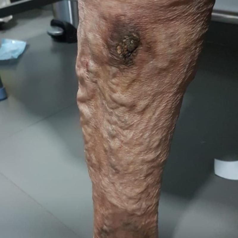 Skin color changes around the veins: reddish-brown or dark purple patches due to iron deposits (hemosiderin) from broken-down blood cells.