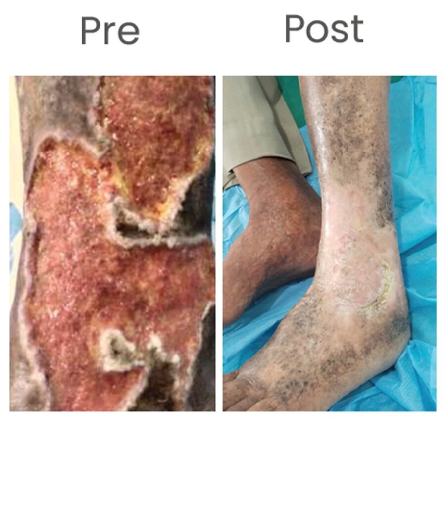 Case of venous ulcer due to chronic DVT: Before & after treatment