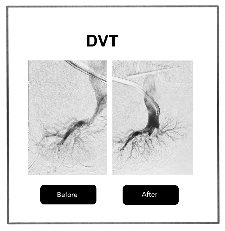 DVT case 2 operated at CIIVES dept with successful outcomes