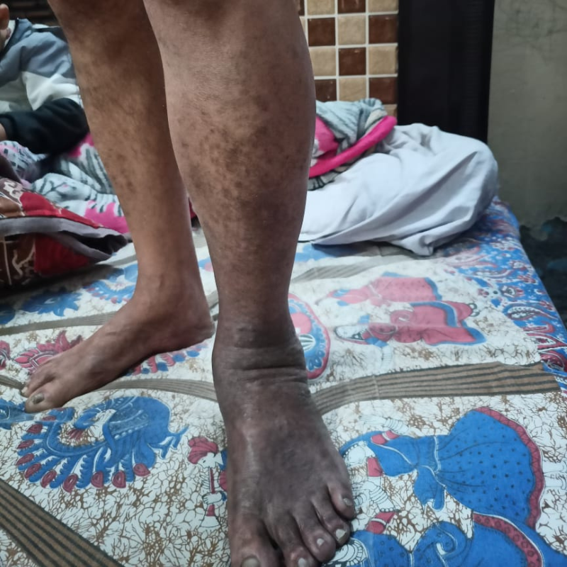 Heaviness or swelling in leg