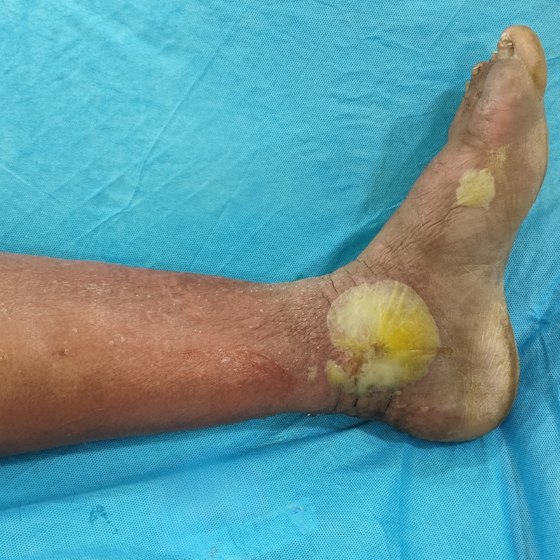 Swelling in leg due to DVT with blisters on foot