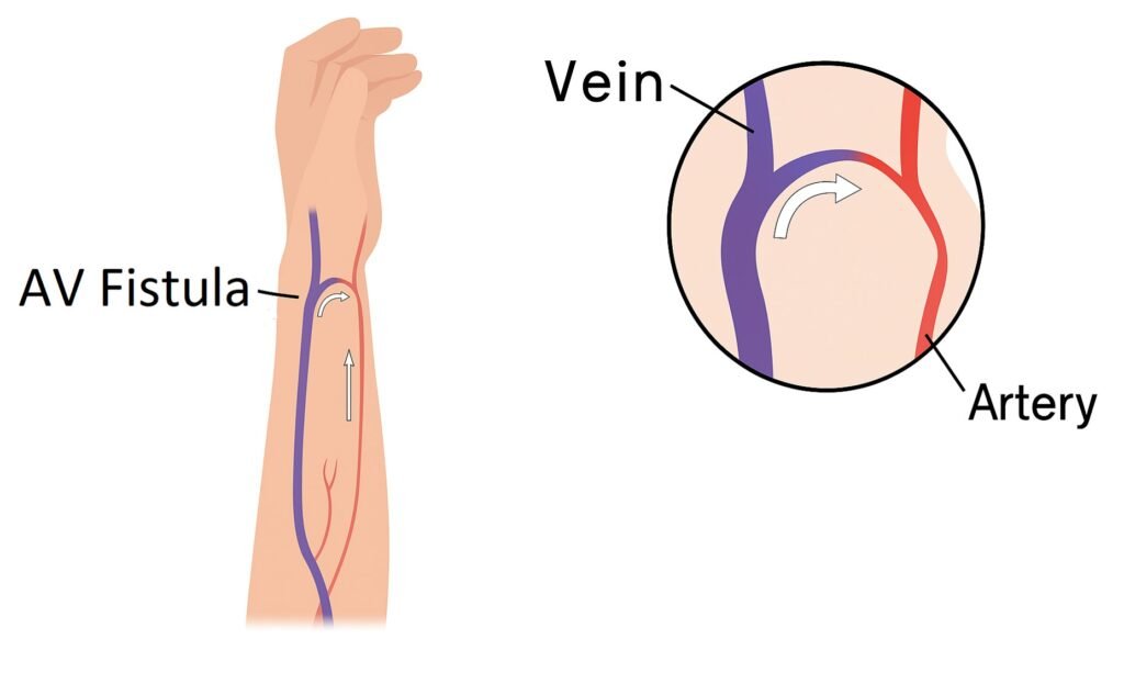 AV Fistula or AVF