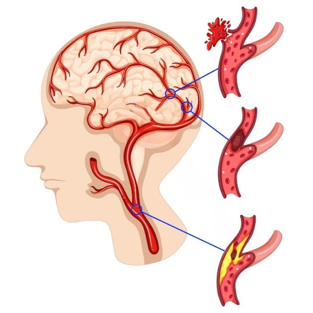 Carotid artery disease