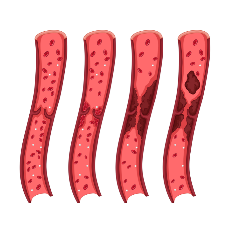 Acute DVT or clot in leg