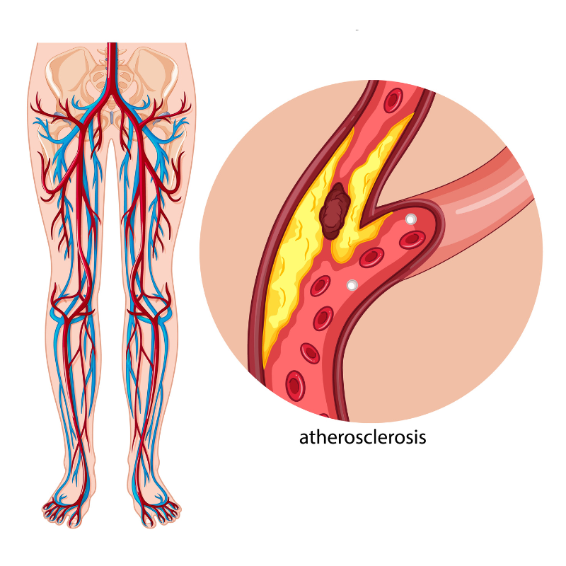 Peripheral artery disease