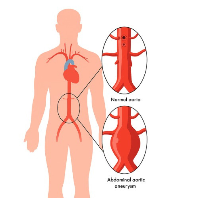 Abdominal aortic aneurysm
