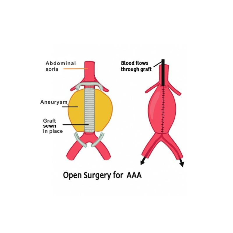 Open surgical repair of aneurysm