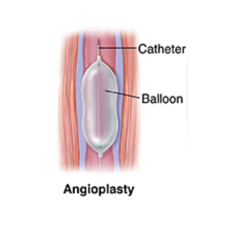 Venoplasty is similar to angioplasty but in the vein