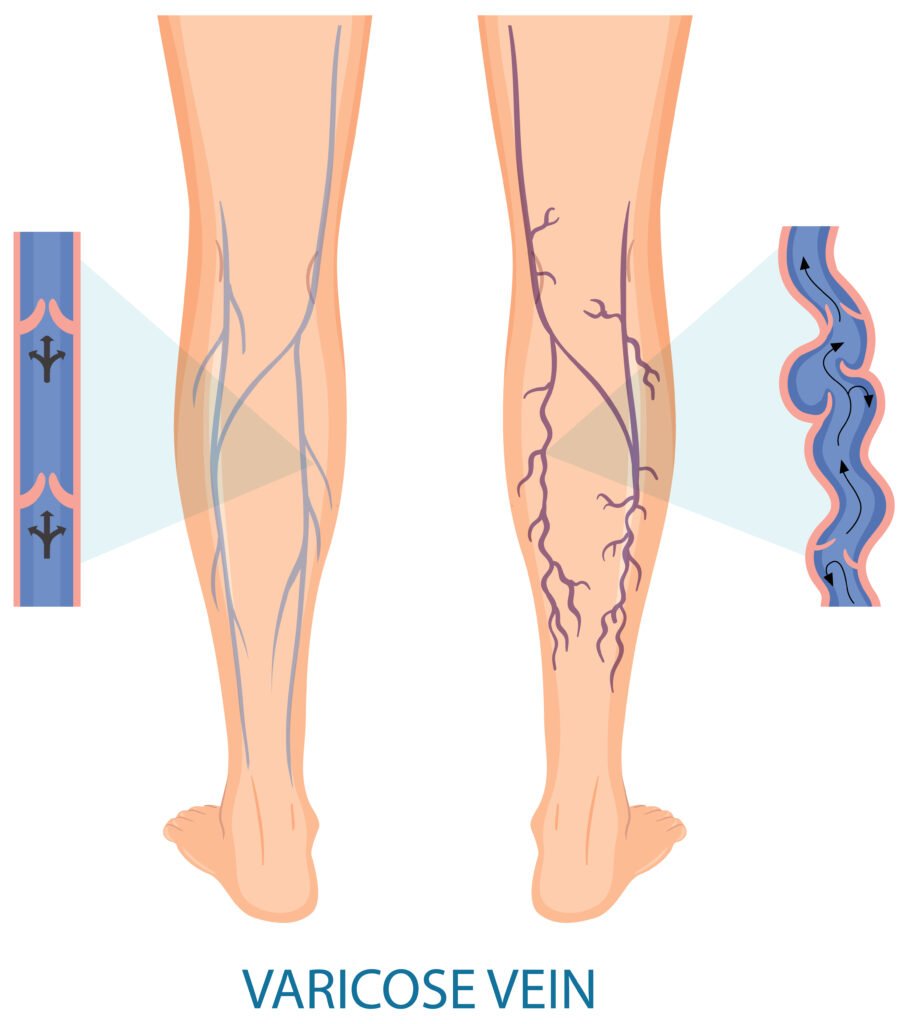 Varicose veins in legs